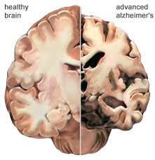 alzheimersnormalbrains